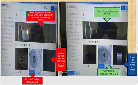 Patient Fixation with IOL Master 700 Biometry