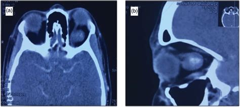 (a) Axial view and (b) sagittal view orbital CT scan of the patient... | Download Scientific Diagram