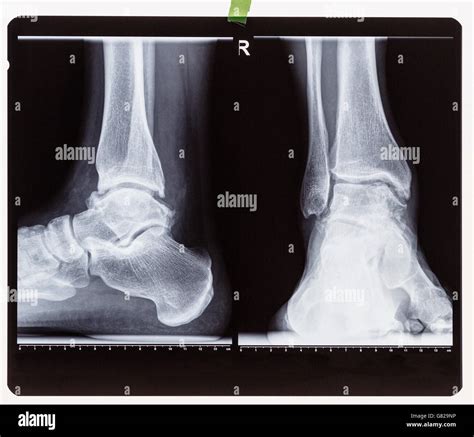 X-ray of the right foot ankle joint Stock Photo - Alamy