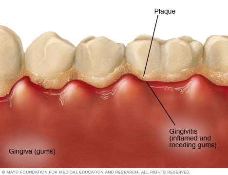 Gingivitis causes symptoms and treatment – Mediologiest