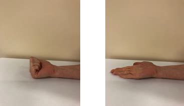 Hand Therapy - Exercises Following Dupuytren's Fasciectomy - North Tees and Hartlepool NHS ...