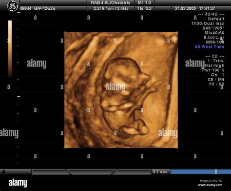 12 Week 3D Ultrasound