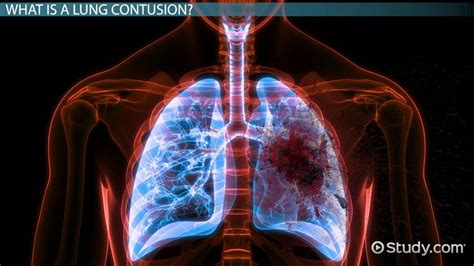 Lung Contusion: Treatment & Recovery Time - Lesson | Study.com