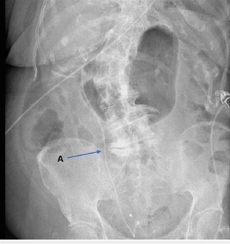 Satisfactory placement of a right-sided ureteric stent (A) on an... | Download Scientific Diagram