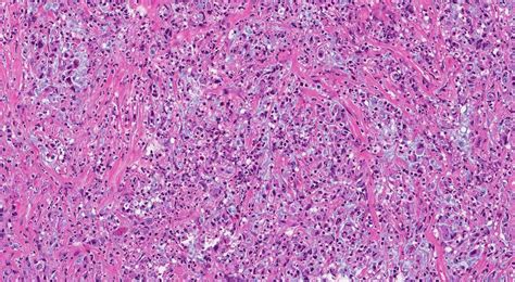 goblet cell adenocarcinoma Archives | Atlas of Pathology