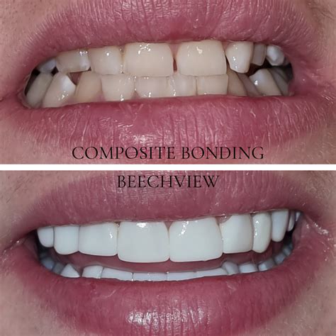 Composite Bonding | Dental Bonding | Teeth Bonding | Beechview Dental