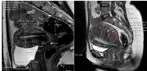 Prediction of Adenomyosis Diagnosis based on MRI - Authorea