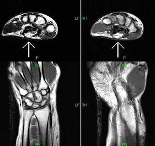 Carpal Tunnel Lipoma-MRI - Sumer's Radiology Blog