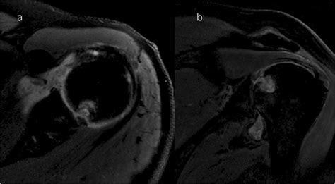 Severe erosive lesion of the glenoid in gouty shoulder arthritis: a case report and review of ...