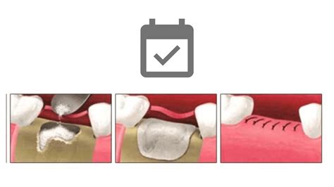 The Different Healing Stages of a Dental Bone Graft