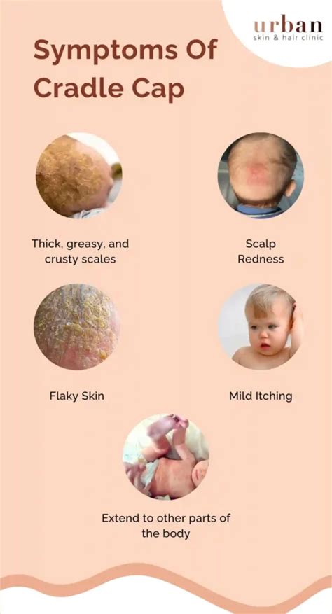 Cradle Cap Types, Causes, Symptoms & Treatment - Urban Skin and Hair Clinic