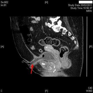 (PDF) Preventable long-term complications of suprapubic cystostomy after spinal cord injury ...