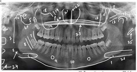 OPG Anatomy Diagram | Quizlet