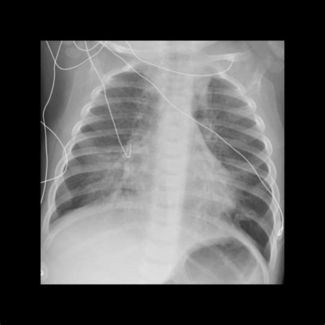 Pediatric Viral Pneumonia | Pediatric Radiology Reference Article | Pediatric Imaging | @pedsimaging