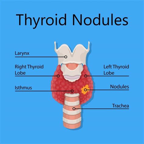 Thyroid Nodules: Key Points You Should Know