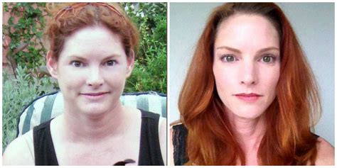 Hypothyroid in photos-Before and After - Stop The Thyroid Madness