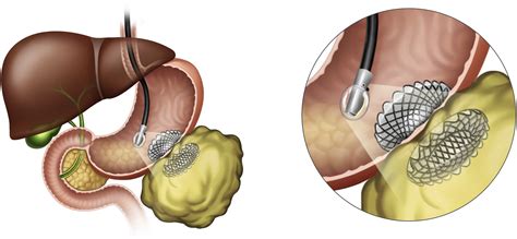 Efficacy of a novel lumen-apposing metal stent for the treatment of ...