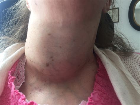 Thyroid Ablation 101: What to do about a massive goiter in a patient unable to have surgery ...