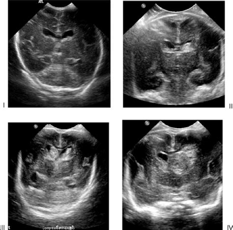 Germinal Matrix Hemorrhage Ultrasound