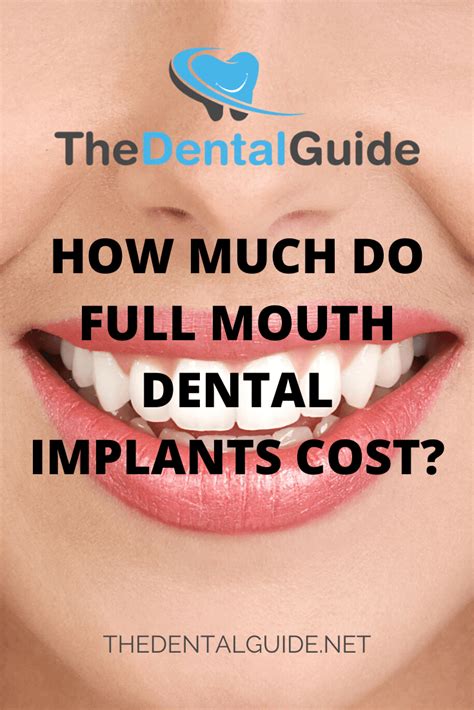 Full Mouth Dental Implants - The Dental Guide