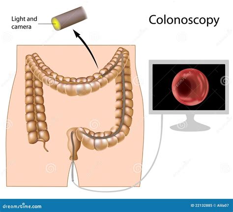 Colonoscopy Procedure Royalty Free Stock Photo - Image: 22132885