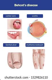 201 Behcet disease Images, Stock Photos & Vectors | Shutterstock