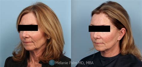 San Diego Ultherapy Before and After Photos