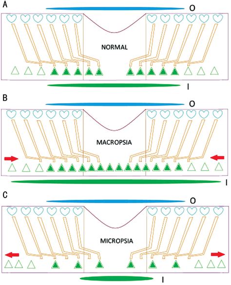 Schematic of the fovea explaining how a compressed and stretched macula ...