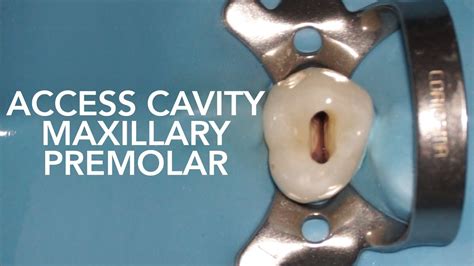 Pre Clinical Endodontic Access Cavity Of Maxillary Premolar, 42% OFF