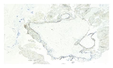 Complete hydatidiform mole slides. Histology and immunohistochemistry ...