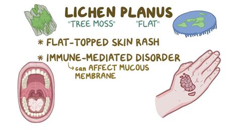 Lichen Simplex: What Is It, Causes, Treatment, and More | Osmosis