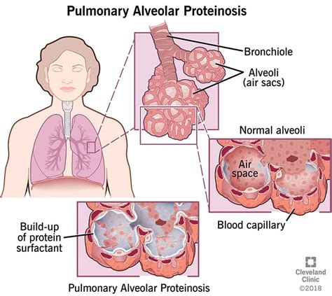 Pulmonary Alveolar Proteinosis: Symptoms & Treatment