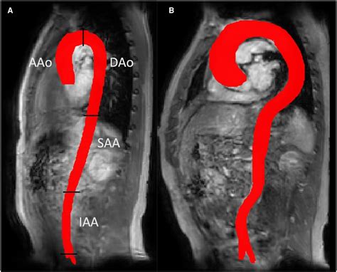 Frontiers | Helical flow in tortuous aortas and its relationship to ...