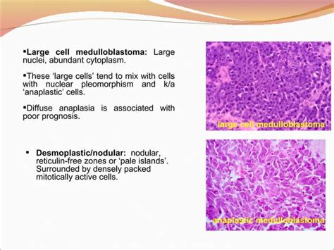 Diagnosis, Treatment & Management of Medulloblastoma