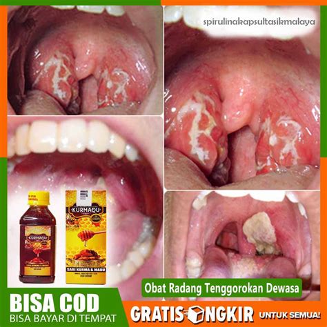 Jual Obat Radang Tenggorokan, Obat Sakit Tenggorokan Anak dan Dewasa Herbal Terbaik Kurmaqu 100% ...