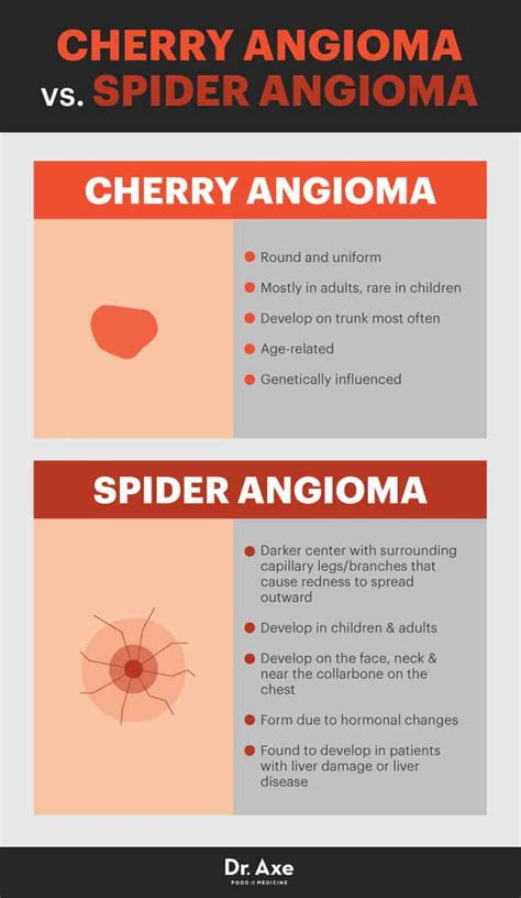 Cherry Angioma Risk Factors, Symptoms & Natural Treatments - Dr. Axe