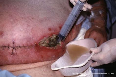 Infected dehisced surgical wound to abdomen in obese patient being irrigated with saline