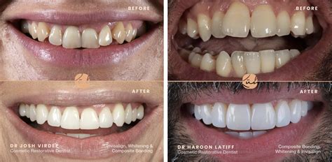 How Composite Bonding can fix crooked teeth | Ruh Dental