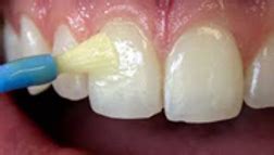 Fluoride Varnish and why the dentist keeps recommending it