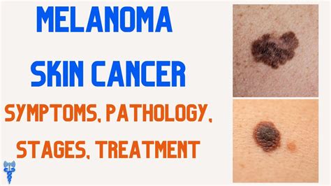 Melanoma Skin Cancer Stages