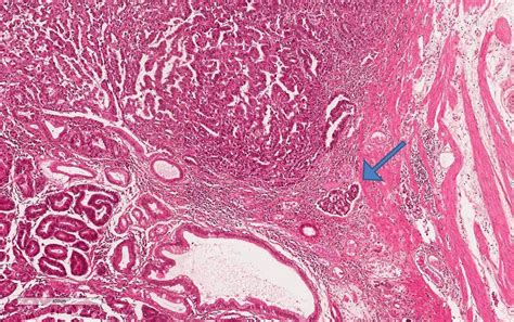 Pathology Outlines - Early gastric carcinoma