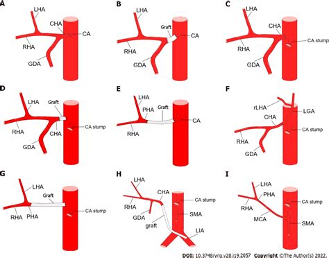 Clinical significance of variant hepatic artery in pancreatic resection: A comprehensive review