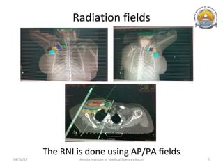 Hypofractionated Radiation Therapy in Breast Cancer