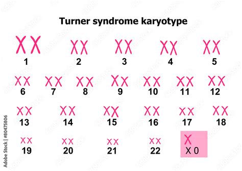 Turner syndrome karyotype Stock Vector | Adobe Stock