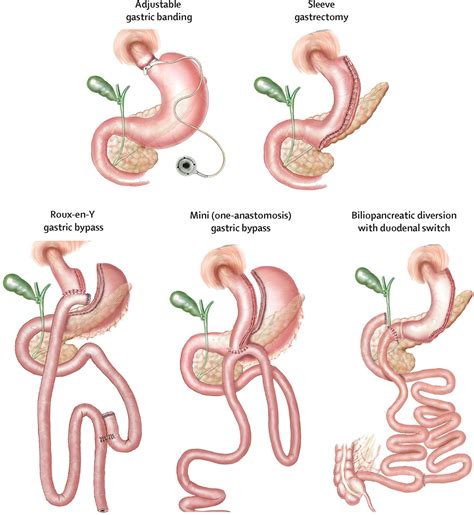 Bariatric Surgery in Turkey / Antalya- TURKEYOBESITYSURGERY