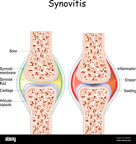 synovitis. Close-up. comparison and difference between a healthy joint ...