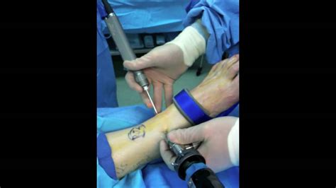 Ankle Arthroscopic Examination & Surgery Video | Removal of Damaged Cartilage - YouTube