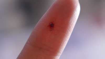 Blood clot in finger: 5 Causes, Symptoms, 10 Home Remedies