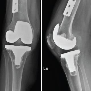 Preoperative total knee prosthesis. | Download Scientific Diagram