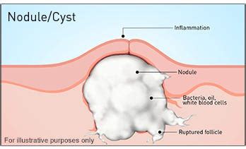 How To Clear Cystic Acne Overnight | by Yasmin Ni | Medium